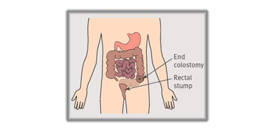 How do you reverse a colostomy?